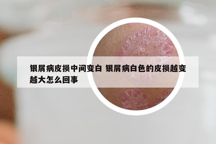 银屑病皮损中间变白 银屑病白色的皮损越变越大怎么回事