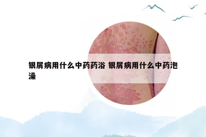 银屑病用什么中药药浴 银屑病用什么中药泡澡