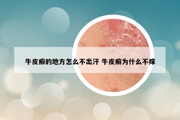 牛皮癣的地方怎么不出汗 牛皮癣为什么不痒