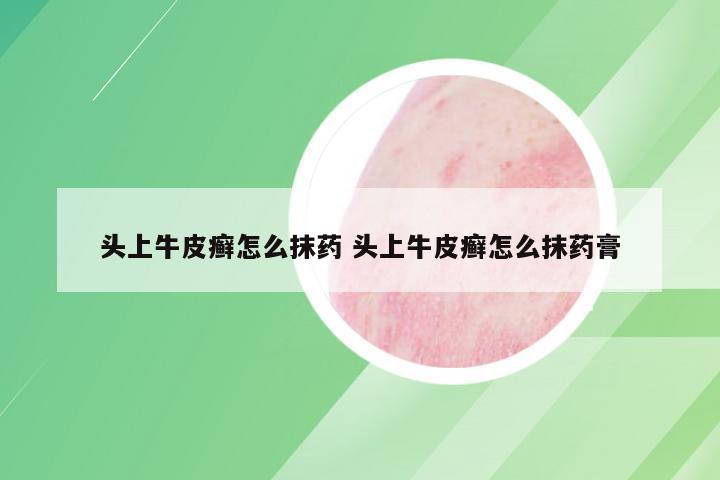 头上牛皮癣怎么抹药 头上牛皮癣怎么抹药膏