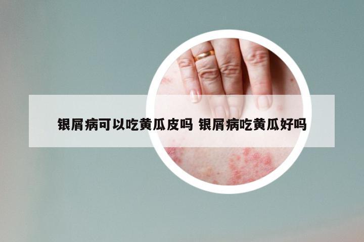 银屑病可以吃黄瓜皮吗 银屑病吃黄瓜好吗