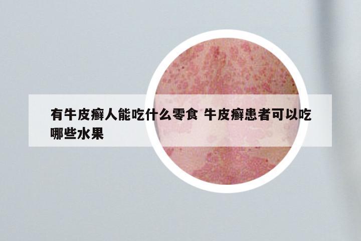 有牛皮癣人能吃什么零食 牛皮癣患者可以吃哪些水果