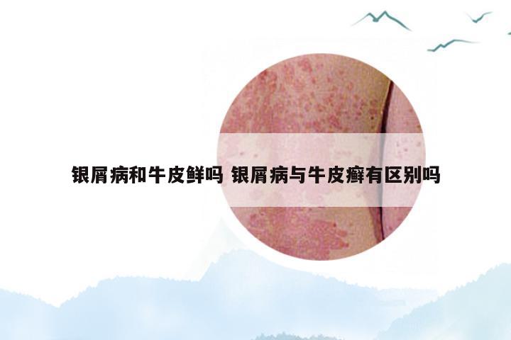 银屑病和牛皮鲜吗 银屑病与牛皮癣有区别吗
