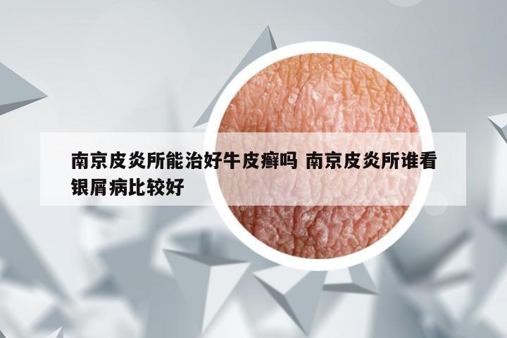 南京皮炎所能治好牛皮癣吗 南京皮炎所谁看银屑病比较好