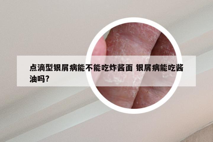 点滴型银屑病能不能吃炸酱面 银屑病能吃酱油吗?