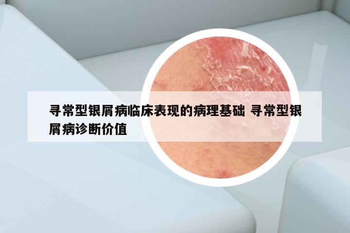 寻常型银屑病临床表现的病理基础 寻常型银屑病诊断价值