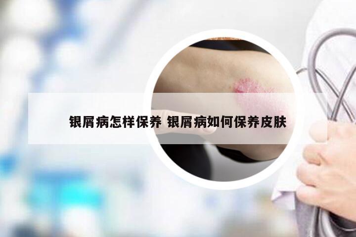 银屑病怎样保养 银屑病如何保养皮肤