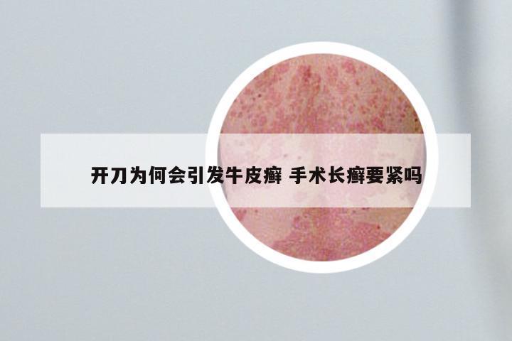 开刀为何会引发牛皮癣 手术长癣要紧吗