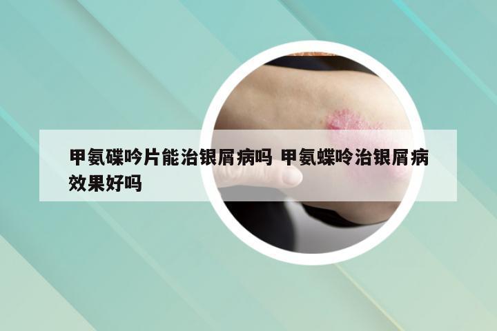 甲氨碟吟片能治银屑病吗 甲氨蝶呤治银屑病效果好吗