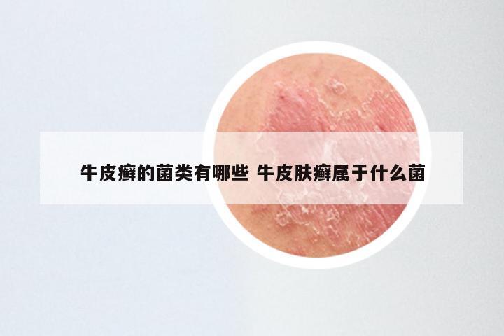 牛皮癣的菌类有哪些 牛皮肤癣属于什么菌