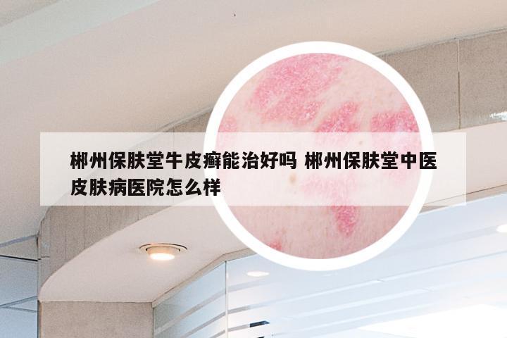 郴州保肤堂牛皮癣能治好吗 郴州保肤堂中医皮肤病医院怎么样