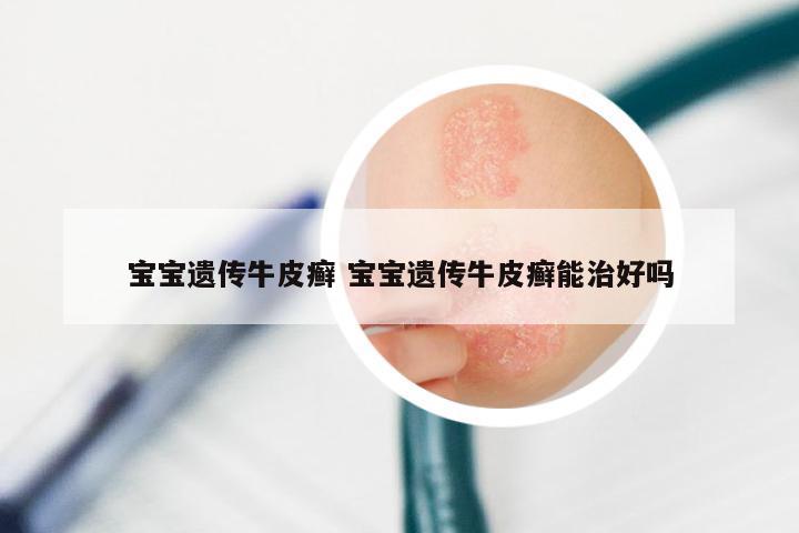 宝宝遗传牛皮癣 宝宝遗传牛皮癣能治好吗