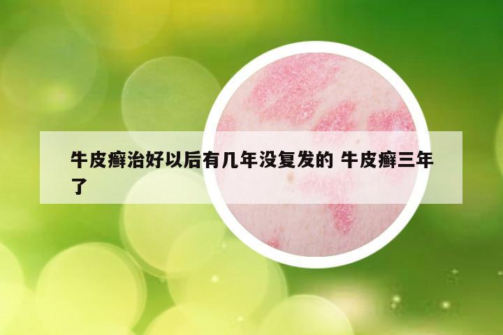 牛皮癣治好以后有几年没复发的 牛皮癣三年了