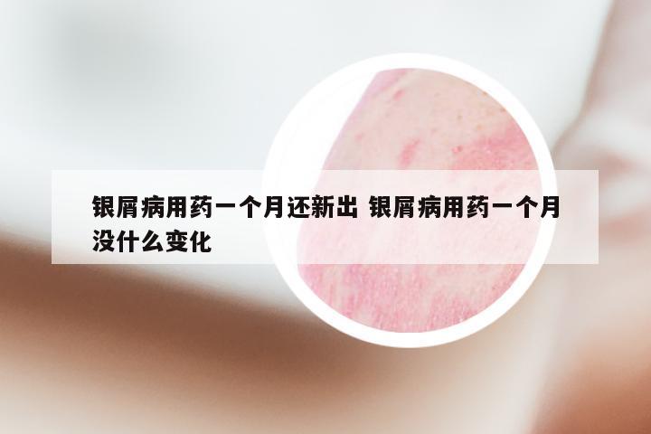 银屑病用药一个月还新出 银屑病用药一个月没什么变化