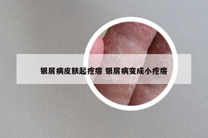 银屑病皮肤起疙瘩 银屑病变成小疙瘩