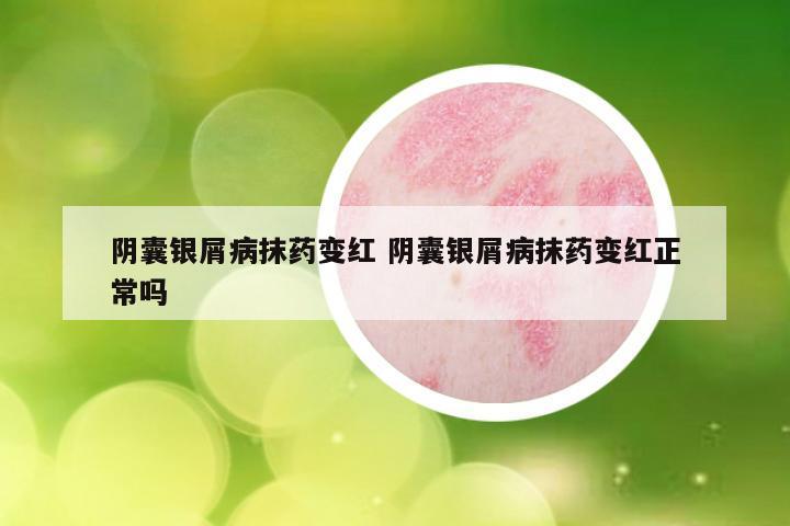 阴囊银屑病抹药变红 阴囊银屑病抹药变红正常吗