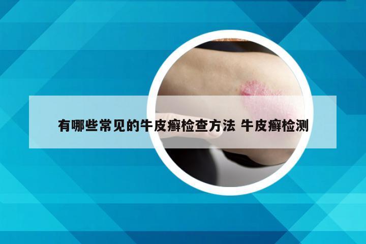 有哪些常见的牛皮癣检查方法 牛皮癣检测