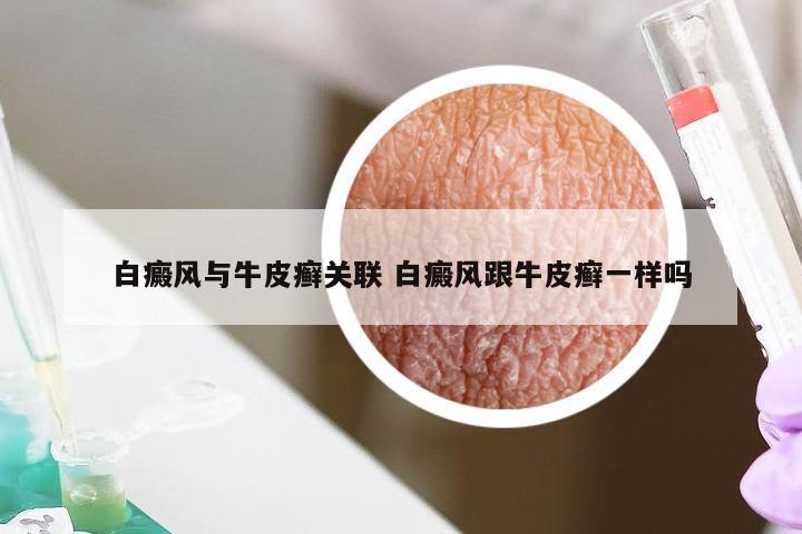 白癜风与牛皮癣关联 白癜风跟牛皮癣一样吗