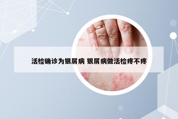 活检确诊为银屑病 银屑病做活检疼不疼