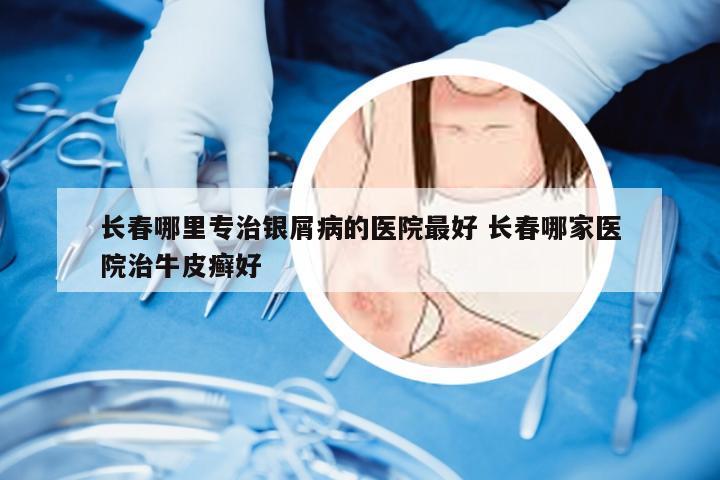 长春哪里专治银屑病的医院最好 长春哪家医院治牛皮癣好