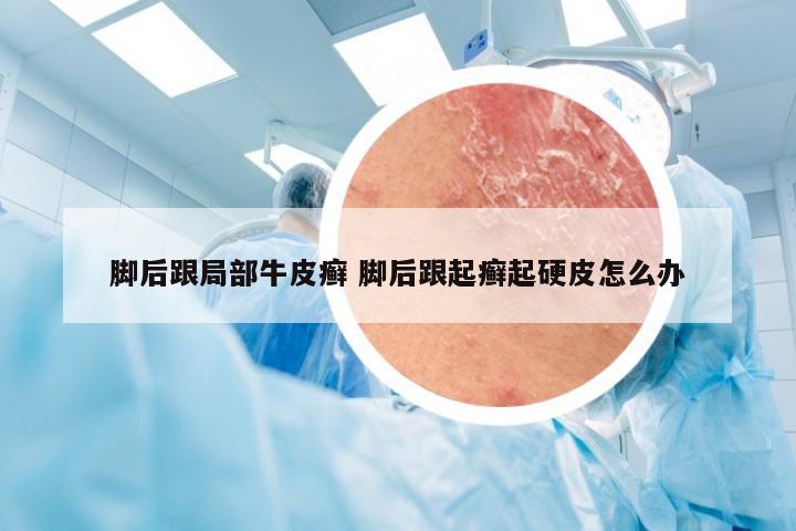 脚后跟局部牛皮癣 脚后跟起癣起硬皮怎么办
