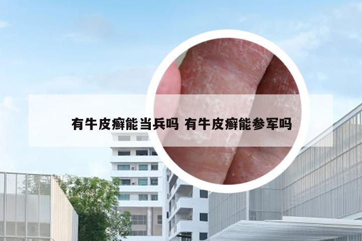 有牛皮癣能当兵吗 有牛皮癣能参军吗