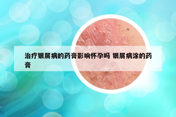 治疗银屑病的药膏影响怀孕吗 银屑病涂的药膏