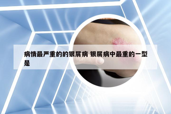 病情最严重的的银屑病 银屑病中最重的一型是