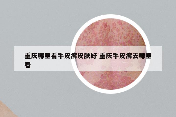 重庆哪里看牛皮癣皮肤好 重庆牛皮癣去哪里看
