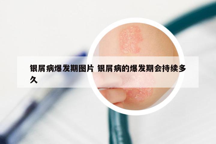 银屑病爆发期图片 银屑病的爆发期会持续多久