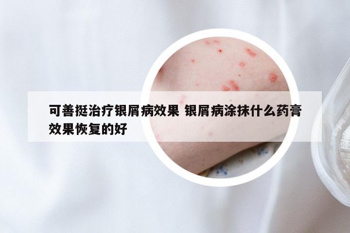 可善挺治疗银屑病效果 银屑病涂抹什么药膏效果恢复的好