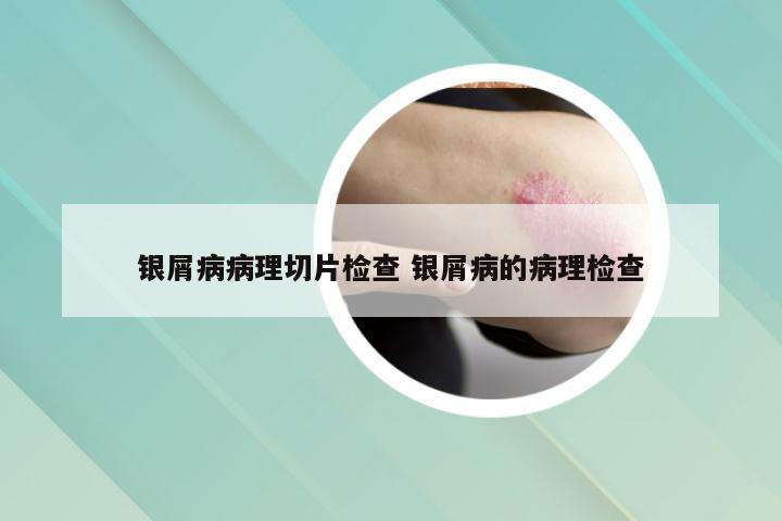 银屑病病理切片检查 银屑病的病理检查