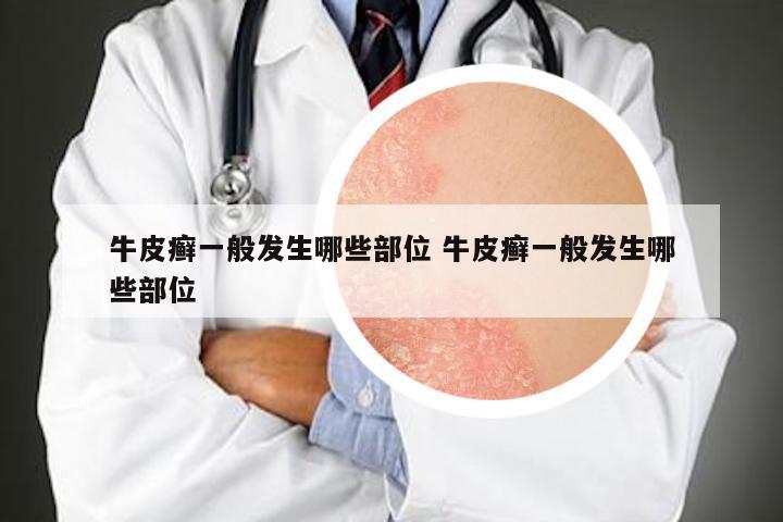 牛皮癣一般发生哪些部位 牛皮癣一般发生哪些部位
