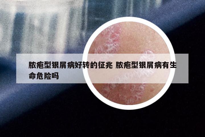 脓疱型银屑病好转的征兆 脓疱型银屑病有生命危险吗
