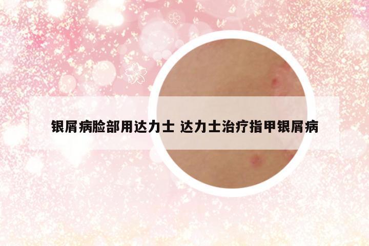 银屑病脸部用达力士 达力士治疗指甲银屑病