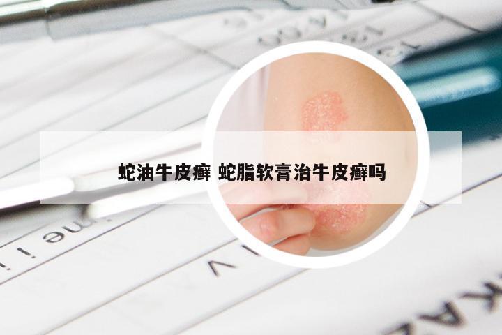 蛇油牛皮癣 蛇脂软膏治牛皮癣吗