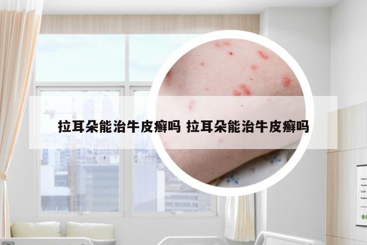 拉耳朵能治牛皮癣吗 拉耳朵能治牛皮癣吗