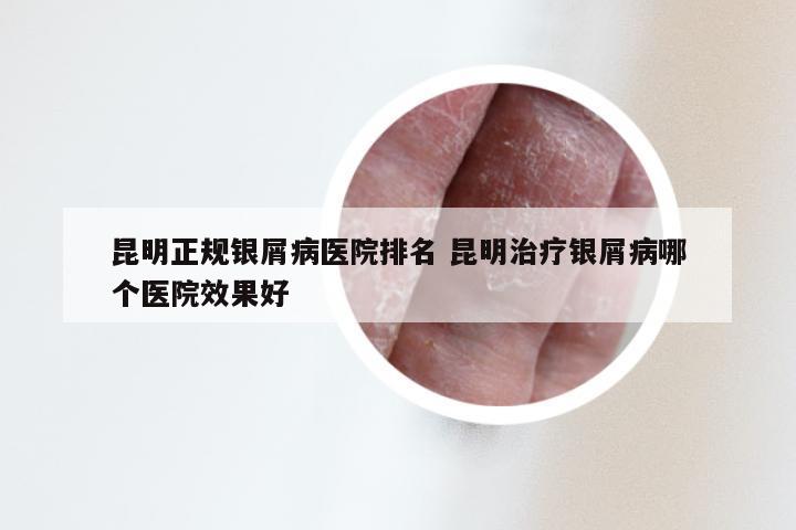 昆明正规银屑病医院排名 昆明治疗银屑病哪个医院效果好