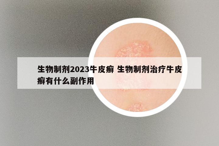 生物制剂2023牛皮癣 生物制剂治疗牛皮癣有什么副作用