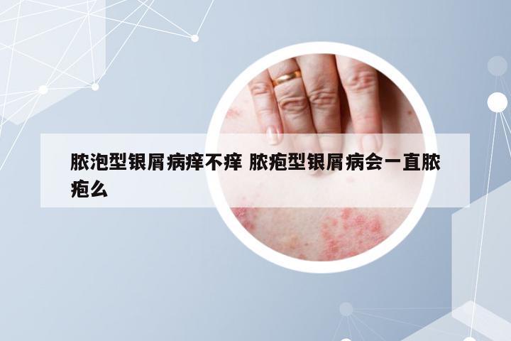 脓泡型银屑病痒不痒 脓疱型银屑病会一直脓疱么