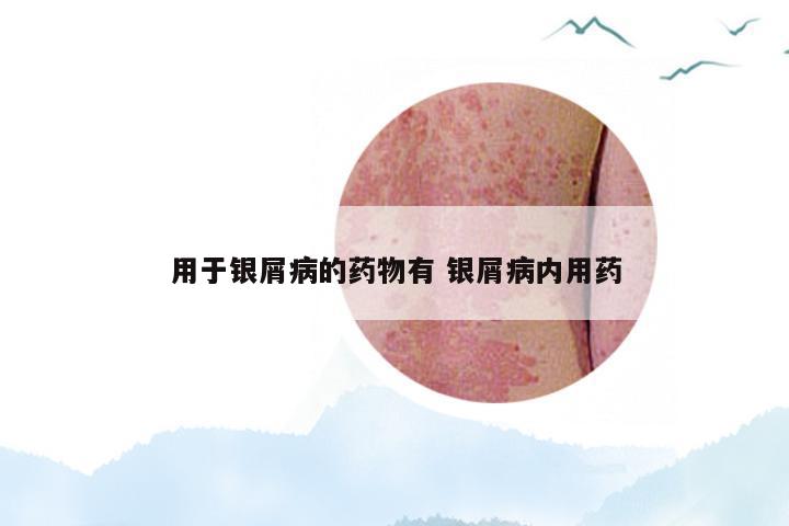 用于银屑病的药物有 银屑病内用药