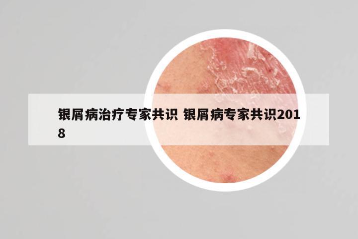 银屑病治疗专家共识 银屑病专家共识2018