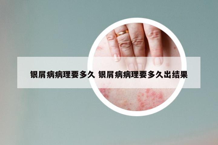 银屑病病理要多久 银屑病病理要多久出结果
