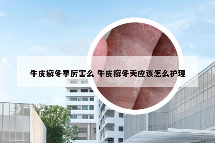 牛皮癣冬季厉害么 牛皮癣冬天应该怎么护理