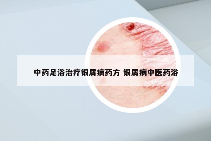 中药足浴治疗银屑病药方 银屑病中医药浴