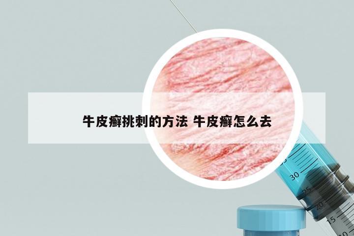 牛皮癣挑刺的方法 牛皮癣怎么去