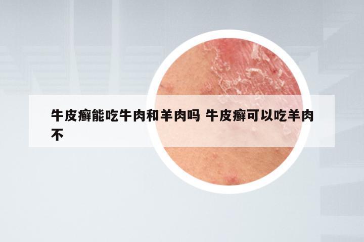 牛皮癣能吃牛肉和羊肉吗 牛皮癣可以吃羊肉不